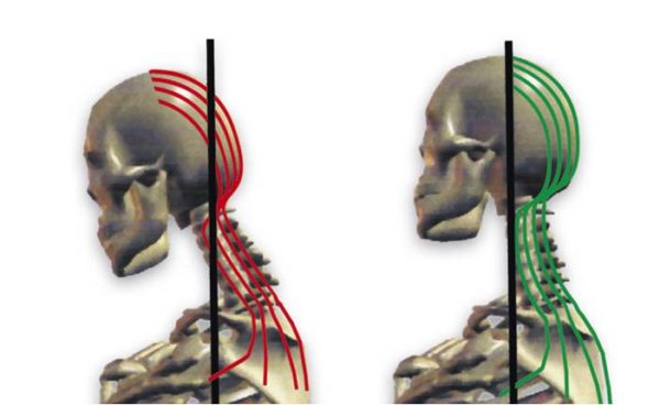 La Rectificaci N De La Lordosis Cervical Y La Quiropr Ctica